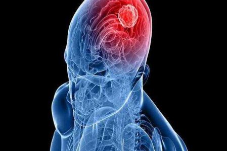 ارتباط داروهای هورمونی ضد بارداری با تومورهای مغزی - خبرگزاری آزیلاز | اخبار ایران و جهان