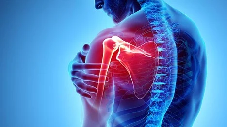 چه داروهای قوی‌تری برای کاهش درد شانه وجود دارند؟
