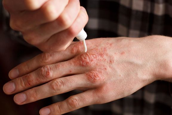 پوست کرم ترک پوستی برای ترک های ناشی از پسوریازیس