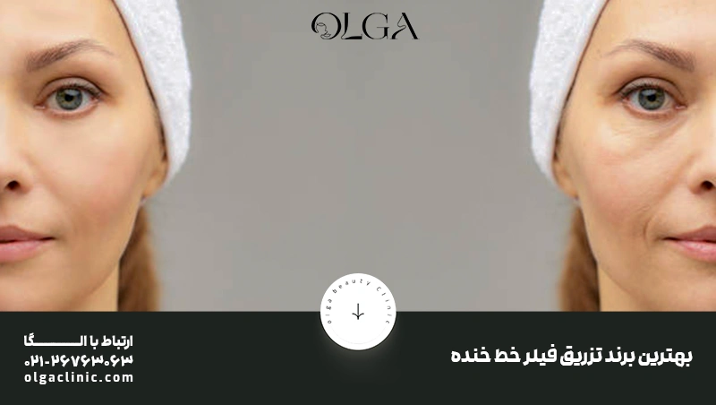 بهترین برند تزریق فیلر خط خنده